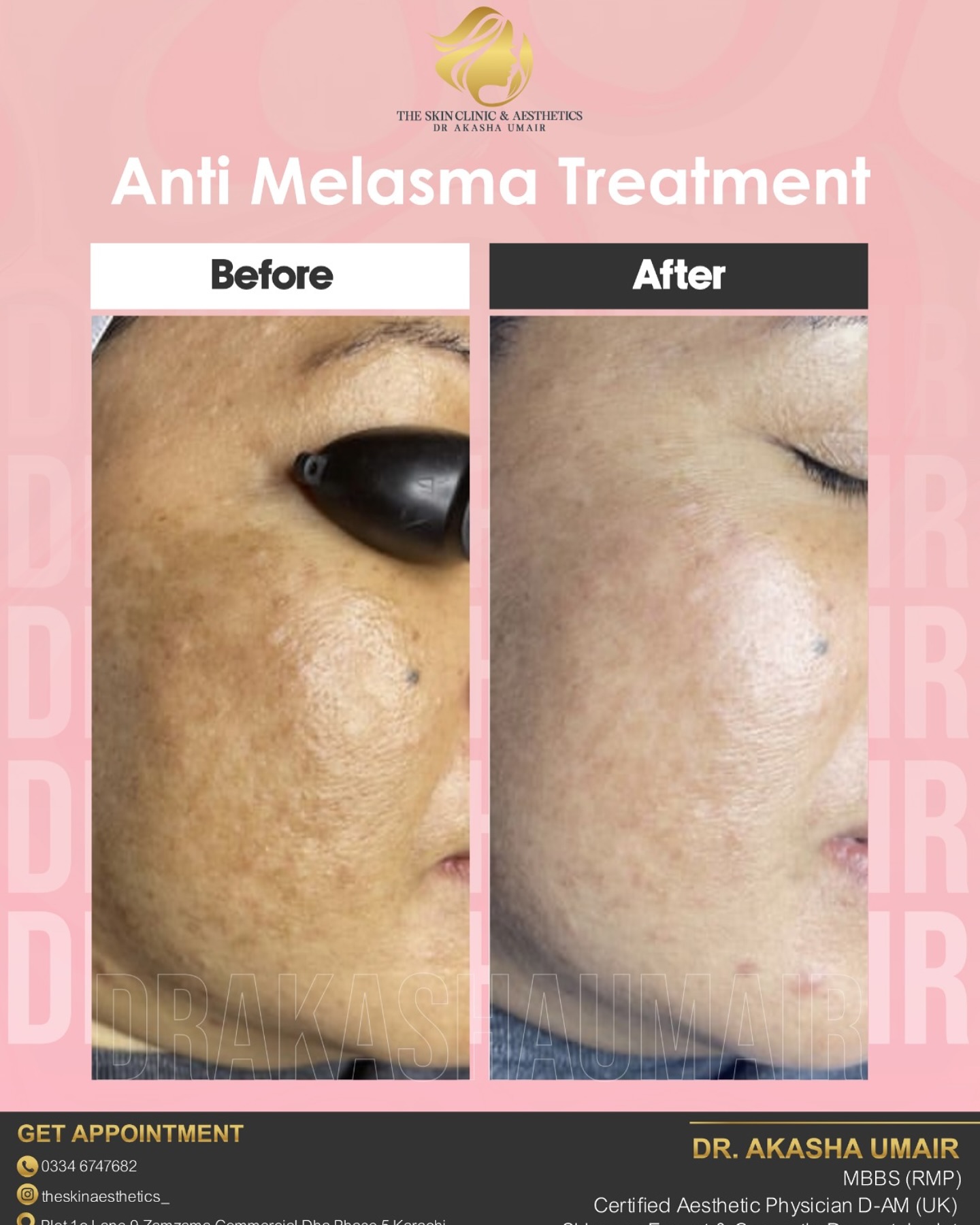 Melasma Treatment