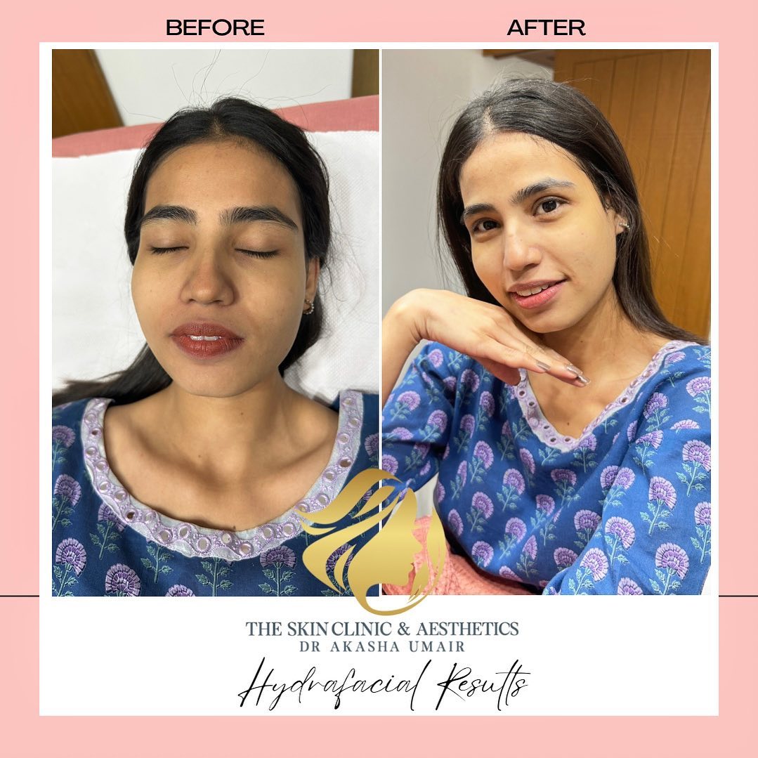 Hydrafacial Glow