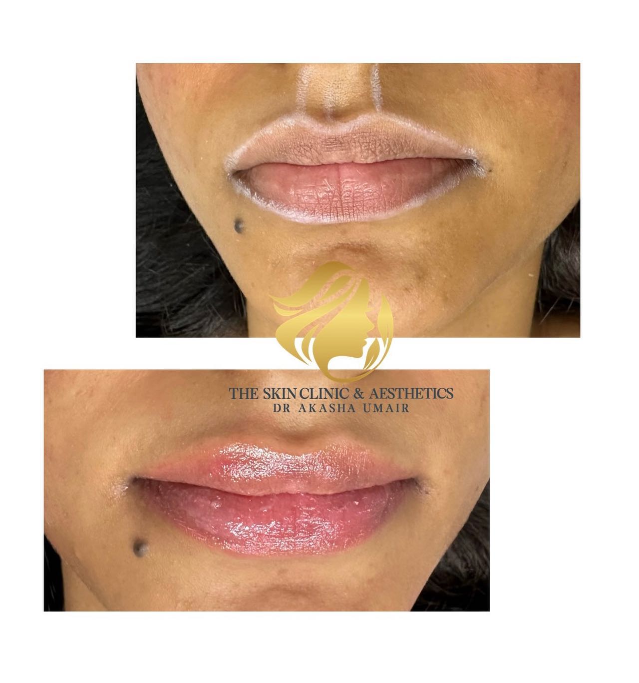 Lip Enhancement