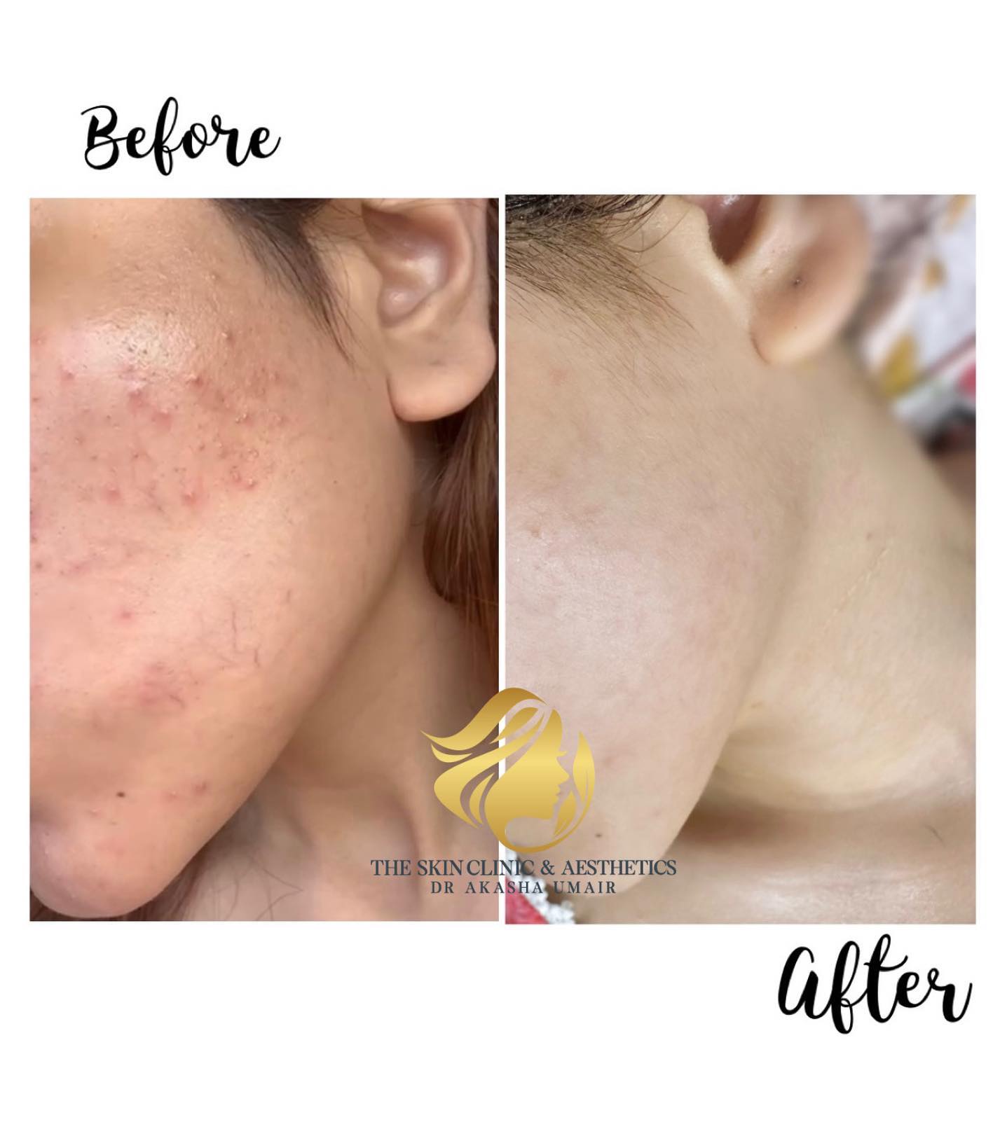 Hydra Facial 