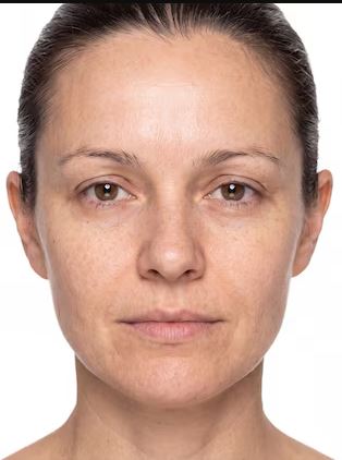 Before Aesthetic Result